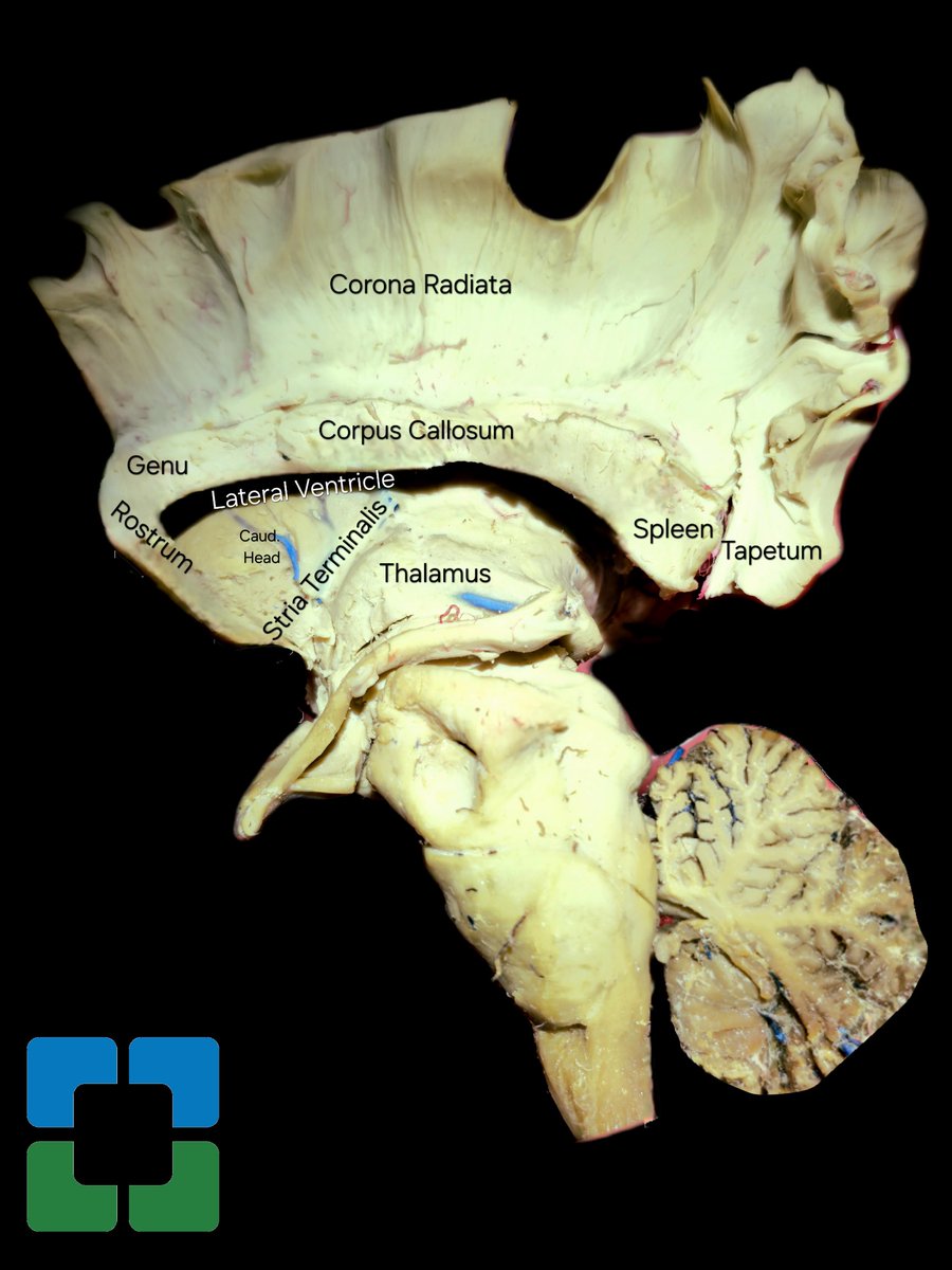 Diving into the intricate details of brain anatomy with a hands-on white matter dissection of the corona radiata in our Skull Base Lab at @CleveClinicFL. Kudos to our skilled research fellow @RoccuzzoDiego for unraveling the complexities of the brain's neural pathways!