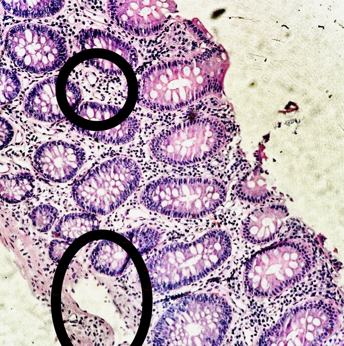 60 year old M with PMHx of alcoholism, cirrhosis and esophageal varices. 

Colonoscopy due to + fecal occult blood test but no polyps noted. Random biopsy below 👇 

Dx?

#pathagonia #pathx #gipath #gastroenterology #medx #liverx #path #medicalstudent #fammed #surgx #hepatology