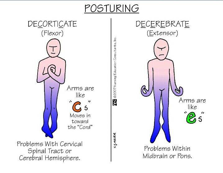 Quick Reference: Abnormal Posturing