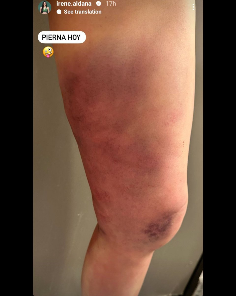 Irene Aldana posts some pics on social media showing her battle wounds from Saturdays CLASSIC fight. 

Irene Aldana, all heart, true fighter. 

#UFC #MMA #Boxing #Irene #IreneAldana