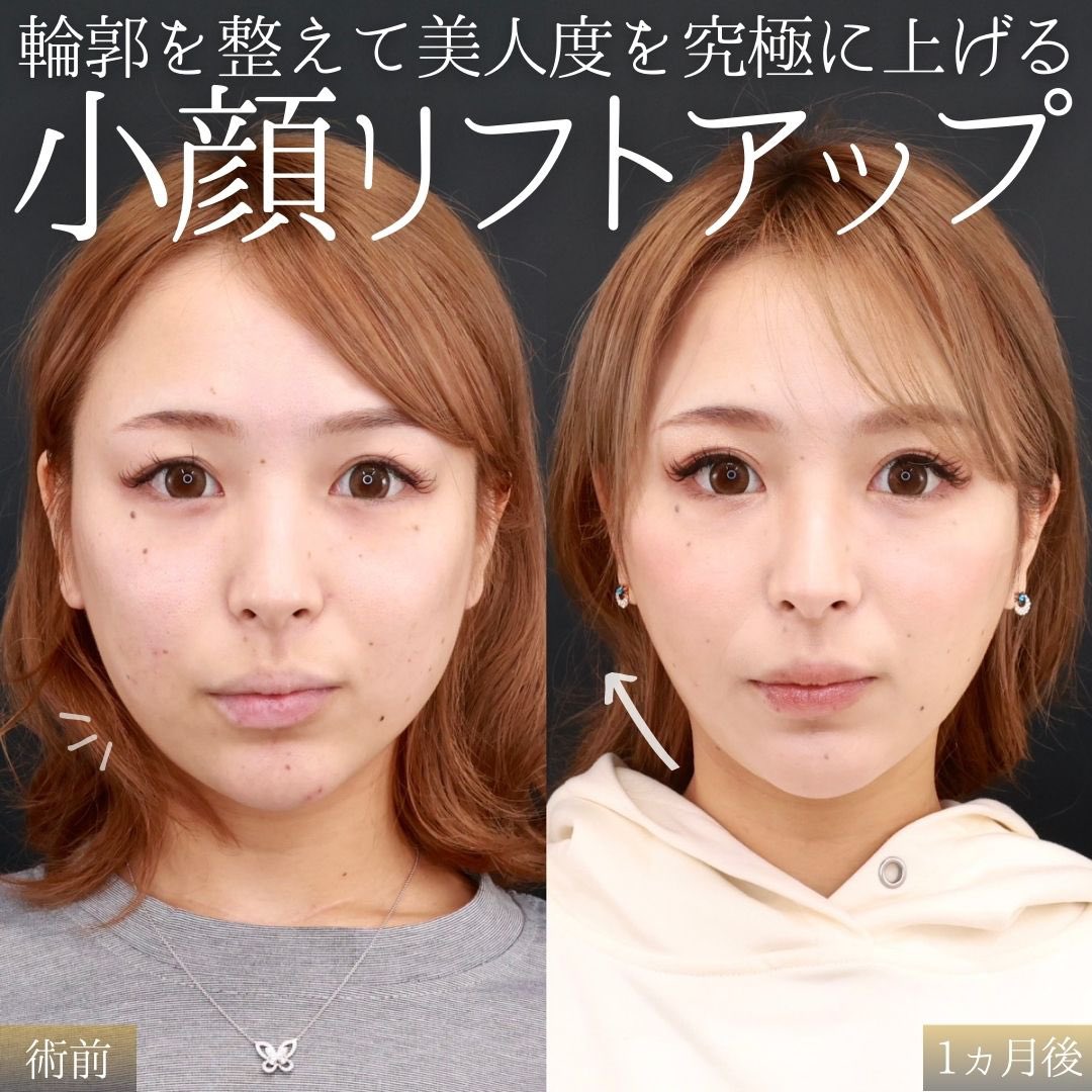 女性の輪郭悩みは骨格と脂肪でどう違う？タイプ別見分け方と小顔施術の費用・実態を徹底比較