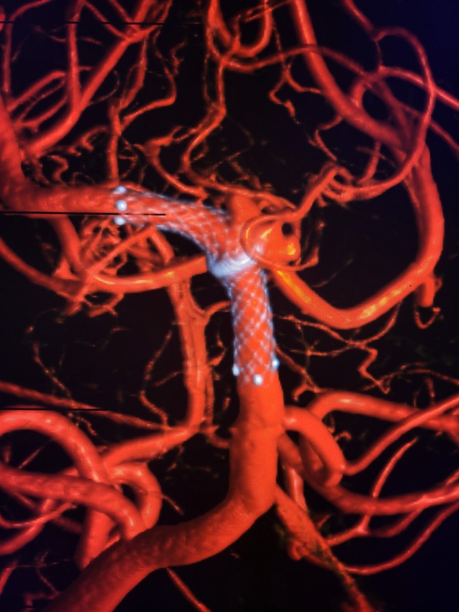 Beautiful fusion of a non-contrast 14s micro dynaCT and 4s contrast 3D spin to demonstrate interaction of EVO stents, aneurysm and parent basilar artery using a Seimens Icono.....SuperDyna protocol @eytanraz @HamedAsadi @neuroangio1 @DPremrl @shapiro_maksim