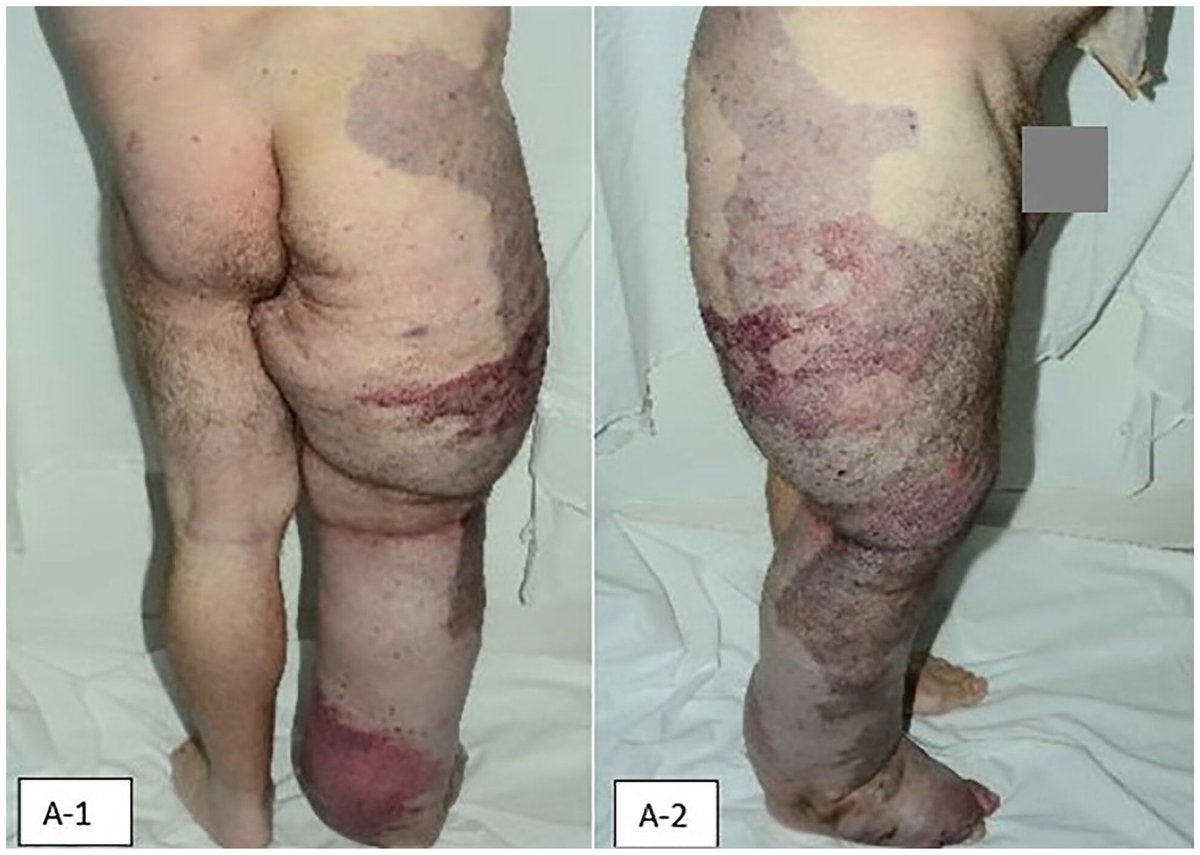 What is the Diagnosis? What is #KTS #VascularMedicine @SVM_tweets
