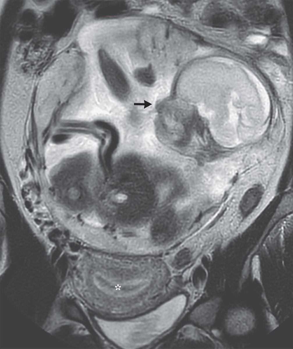Read this interesting case in @NEJM 

nejm.org/doi/full/10.10…

By Guillaume Gorincour, M.D., Ph.D., and Malik Boukerrou, M.D., Ph.D.

A 37-year-old woman presented with a 10-day history of abdominal pain. Physical examination was notable for a gravid abdomen.
