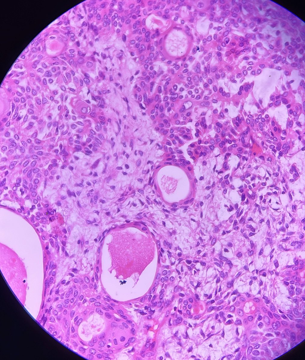 Nodular growth, orbit 
#pathology #surgpath #pathtwitter #pathresidents