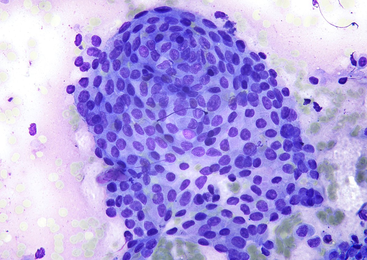 SUBTLE touch of “onion skinning”, Papillary Thyroid Carcinoma, FNA.