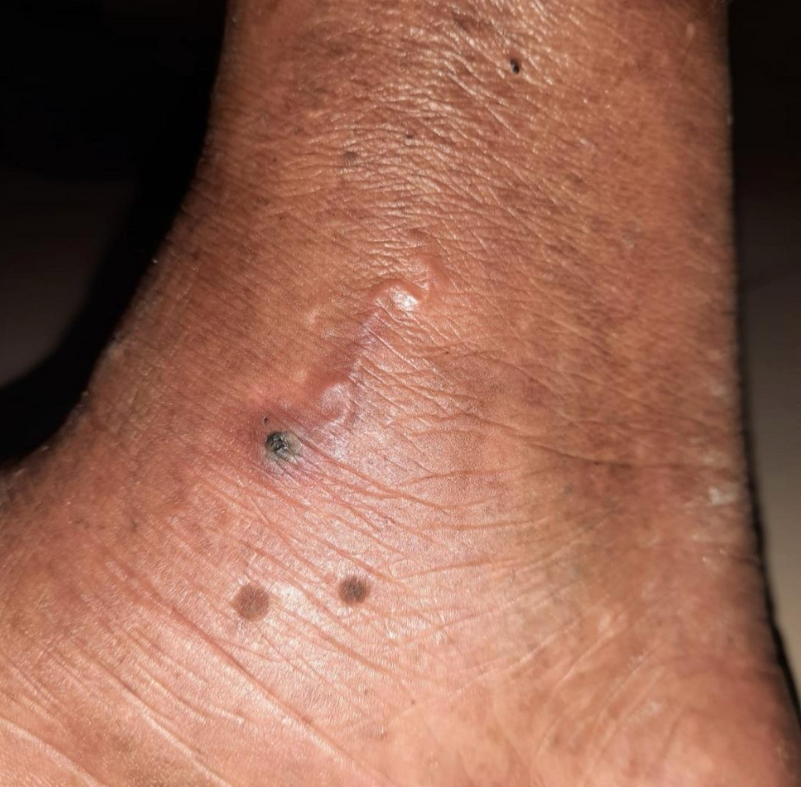marrow_med's tweet photo. Farmer with h/o walking barefoot presents with a painful, erythematous lesion as shown. Blood picture shows mild eosinophilia.
What is the probable diagnosis &amp; treatment? https://t.co/b9MCRDTBtZ