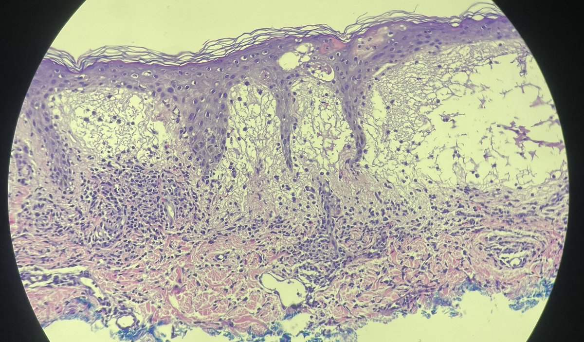 david_terrano's tweet image. 40yo. Vague GI symptoms and subsequent rash of edematous and erythematous plaques, starting intertriginous, spreading to trunk and extremities. First pruritus, then tender. No response to low dose steroids. Completely cleared after higher dose. Thx @mccalmo for lighting the way.