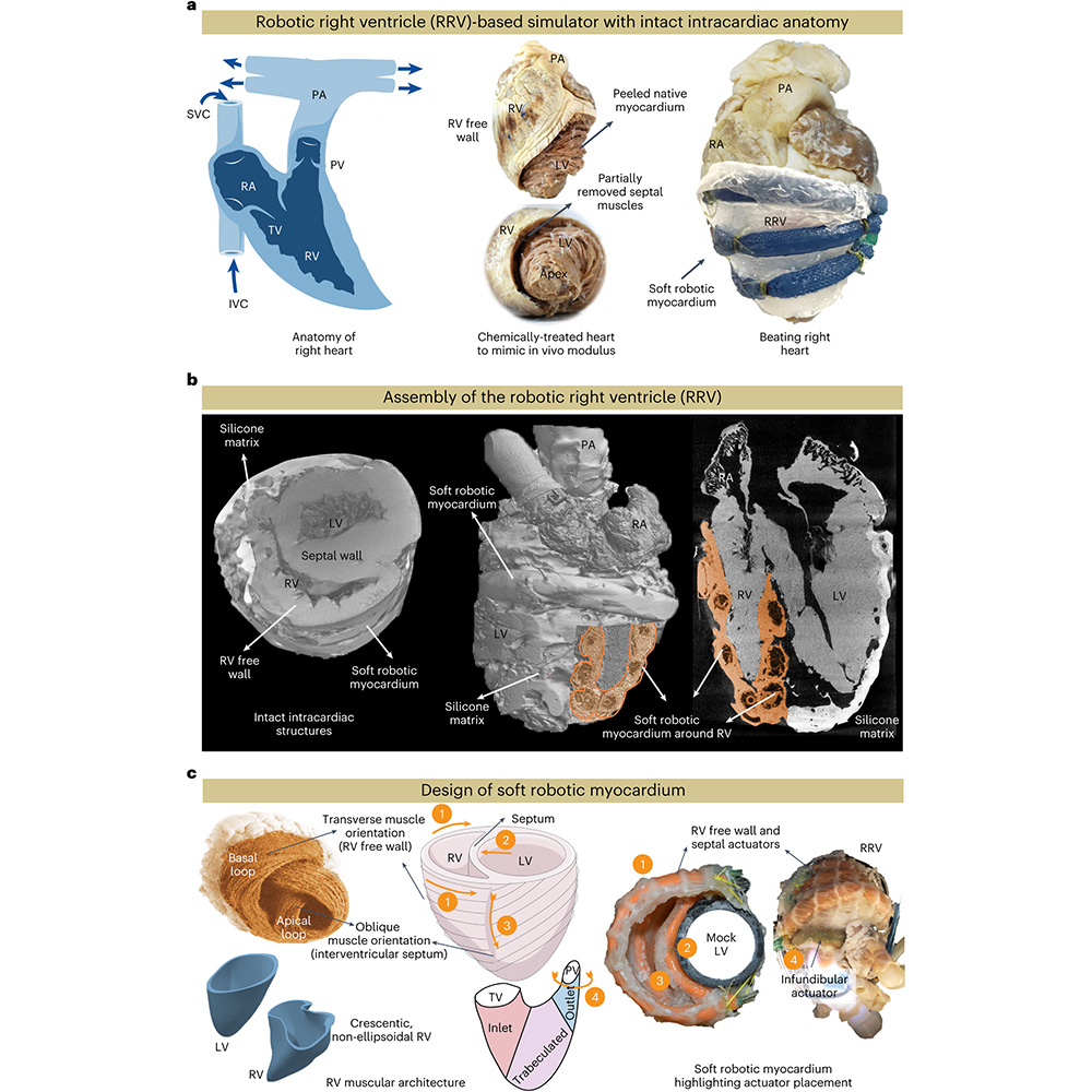 Nature Portfolio (@natureportfolio) on Twitter photo A paper in <a href="/NatureCVR/">Nature Cardiovascular Research</a> presents a soft robotic model that can mimic the right ventricular motion and hemodynamics in healthy and pathological conditions and can be used as an in vitro simulator for tricuspid valve repair and replacement. go.nature.com/41js4CF A paper in <a href="/NatureCVR/">Nature Cardiovascular Research</a> presents a soft robotic model that can mimic the right ventricular motion and hemodynamics in healthy and pathological conditions and can be used as an in vitro simulator for tricuspid valve repair and replacement. go.nature.com/41js4CF