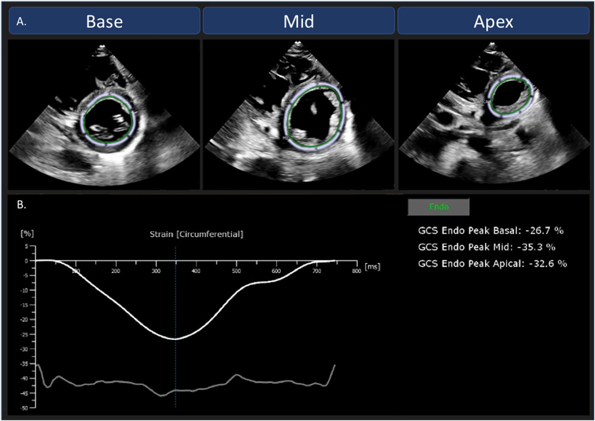 In patients with cardiac amyloidosis (CA), left ventricular ejection fraction (LVEF) is frequently preserved, despite commonly reduced global longitudinal strain (GLS). Read our @JournalASEcho article: bit.ly/41yIUhi