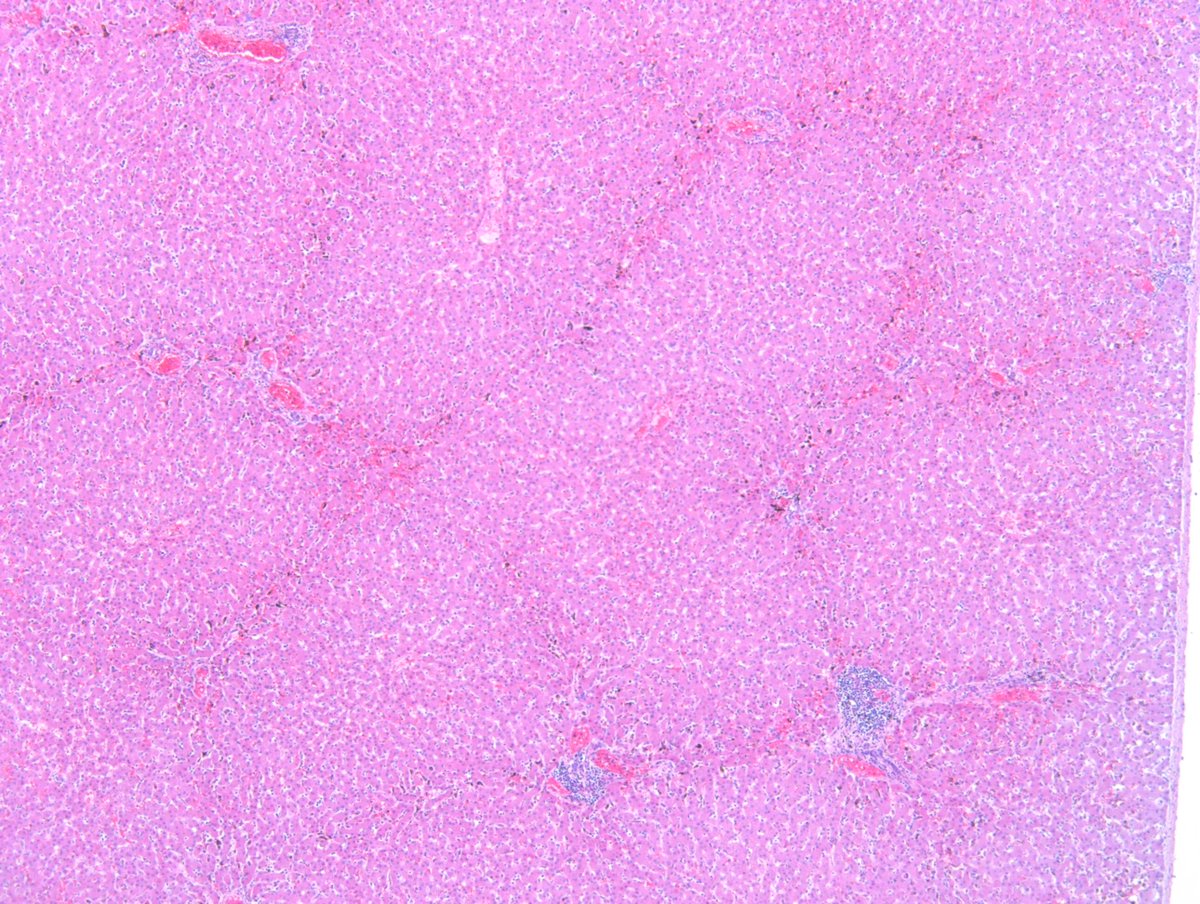 Richard Carr (@racarr51) on Twitter photo MP1: Brain cortex: Nearly every capillary RBC infected by unpigmented parasites (P. falciparum) - rare. Sparse malaria pigment from previous schizogeny. MP1: Liver with haemozoin in sinusoids, lack of parasitised RBC in sinusoids. <a href="/BloodScientist/">Anas Nasir</a> <a href="/ttmalawi/">Terrie Taylor</a> MP1: Brain cortex: Nearly every capillary RBC infected by unpigmented parasites (P. falciparum) - rare. Sparse malaria pigment from previous schizogeny. MP1: Liver with haemozoin in sinusoids, lack of parasitised RBC in sinusoids. <a href="/BloodScientist/">Anas Nasir</a> <a href="/ttmalawi/">Terrie Taylor</a>