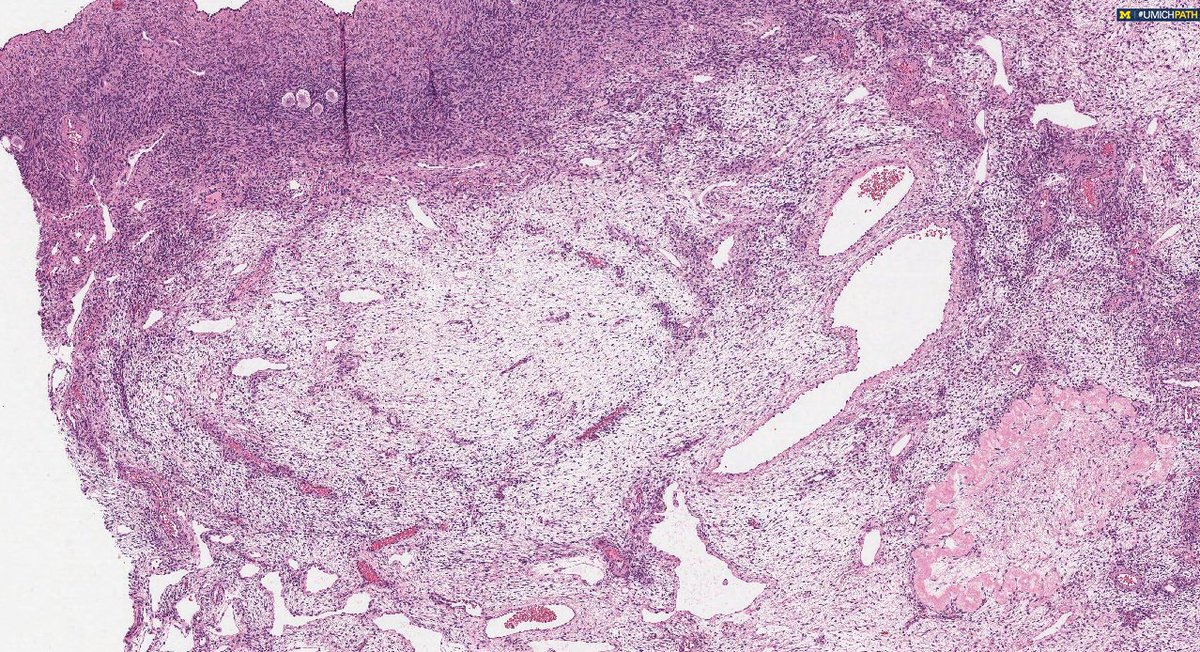 Michigan Pathology (@umichpath) on Twitter photo 🔬Check out this #COTW from <a href="/sarahnfarran/">Sarah Farran, MD, MPH</a>!
A 22 y.o. presents with flank & abdominal pain, progressively getting worse, following a spontaneous vaginal delivery. A 7 cm complex right adnexal mass is observed on imaging. What is your diagnosis? Which stains could help support it? 🔬Check out this #COTW from <a href="/sarahnfarran/">Sarah Farran, MD, MPH</a>!
A 22 y.o. presents with flank & abdominal pain, progressively getting worse, following a spontaneous vaginal delivery. A 7 cm complex right adnexal mass is observed on imaging. What is your diagnosis? Which stains could help support it?