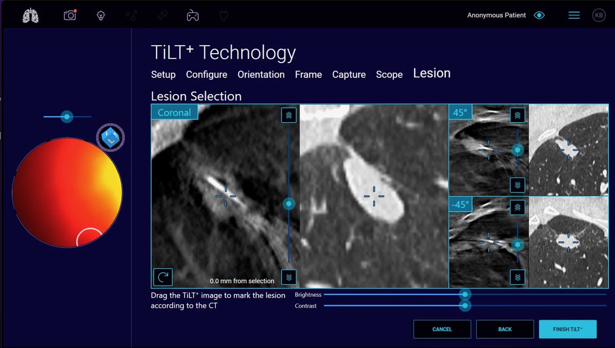 Bhadra & Condra CBCT Bronchoscopy tweet media