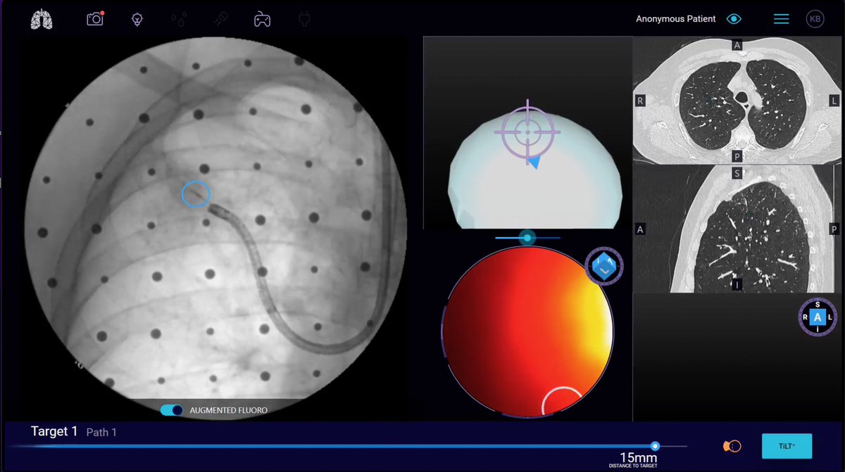 2/2, RUL @NoahMedical 

#galaxysystem #noahmedical #roboticbronchoscopy #interventionalradiology #interventionalpulmonology