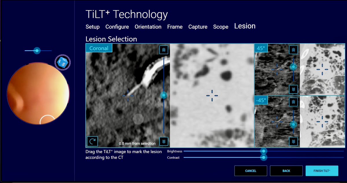 Bhadra & Condra CBCT Bronchoscopy tweet media