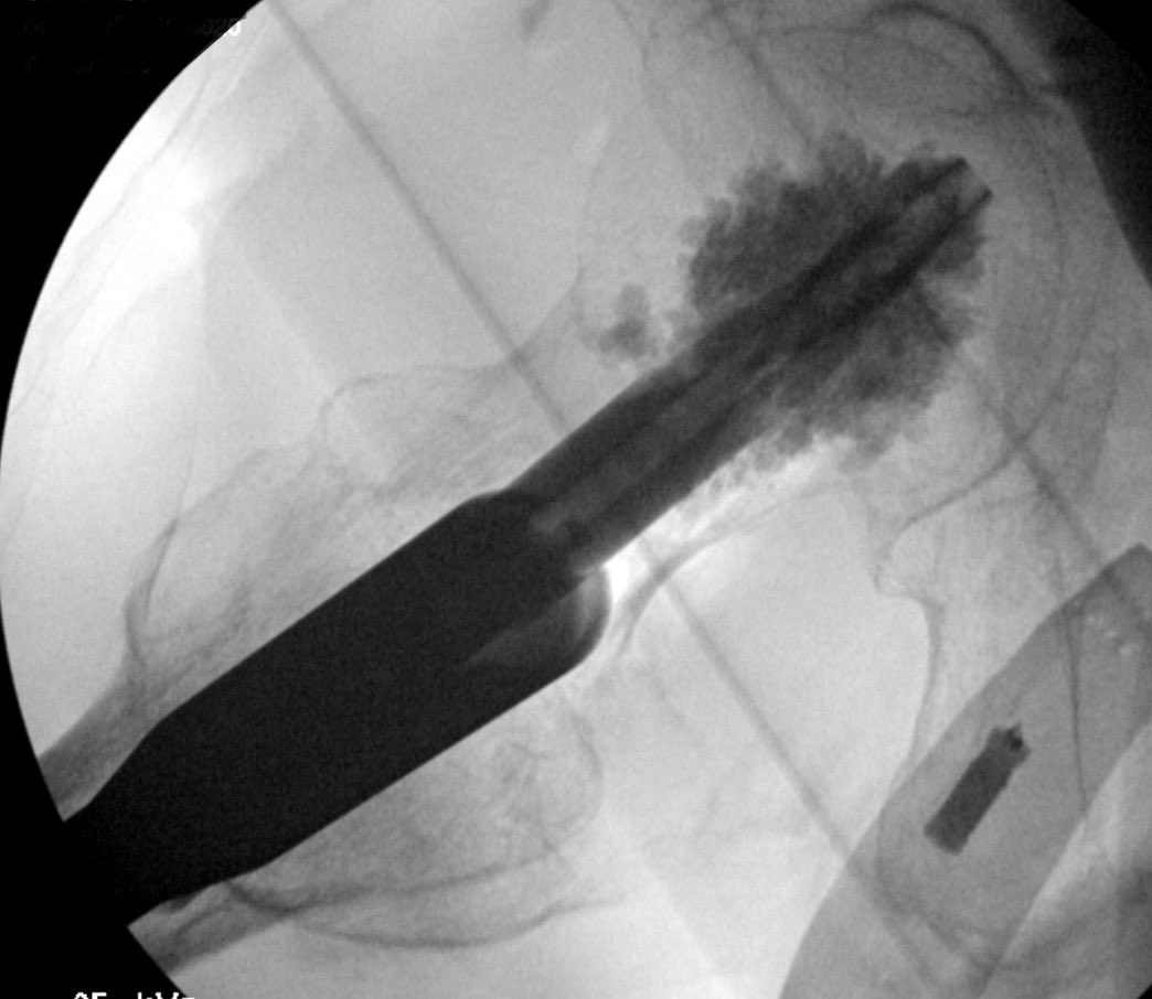 Simple pertroch made easy with the Hana table…it’s not just for anterior hips! Nice case to teach residents fracture principles and different techniques for indirect reduction. @BalboaOrtho