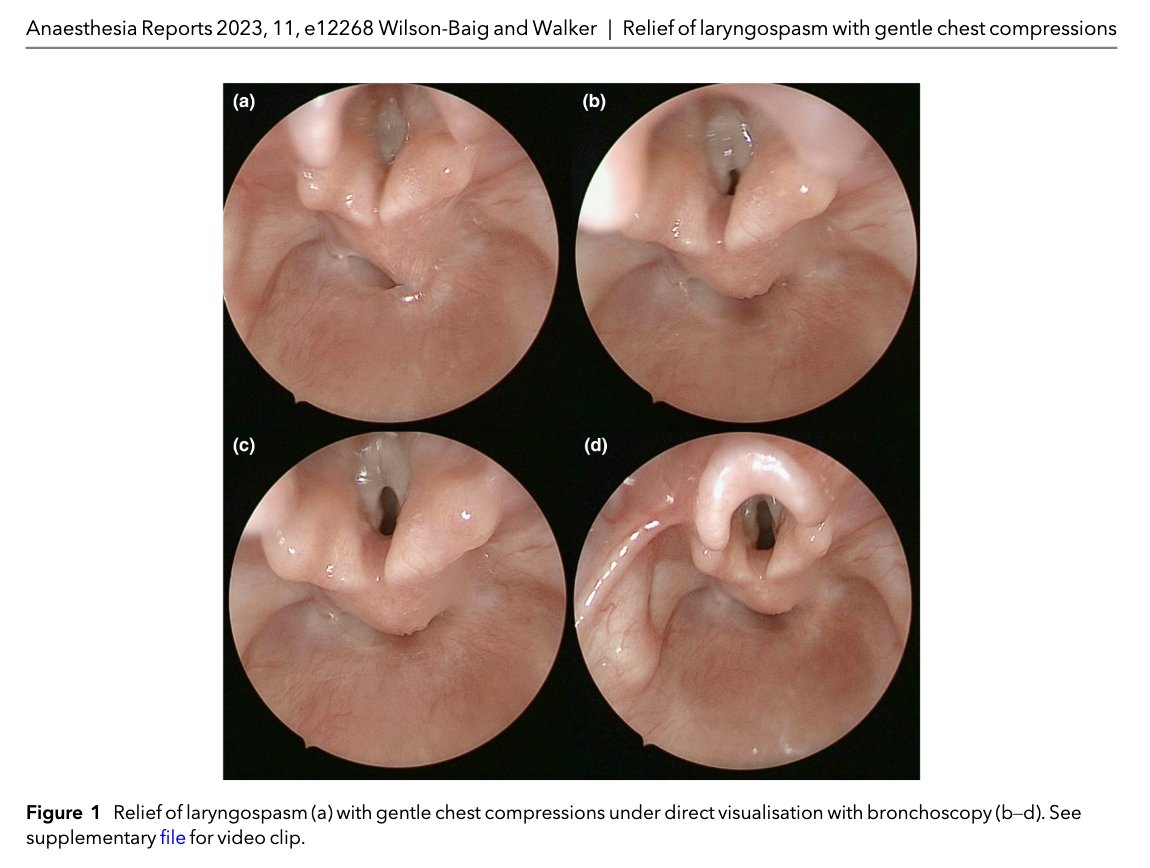 Have you ever used chest compressions to relieve laryngospasm?

<a href="/LeDyslexicMedic/">noamaan wilson-baig</a> and Walker have! 

Read about it at the link below.

(Hint: They kindly recorded their experience - there's also a video!)

…-publications.onlinelibrary.wiley.com/doi/full/10.10…