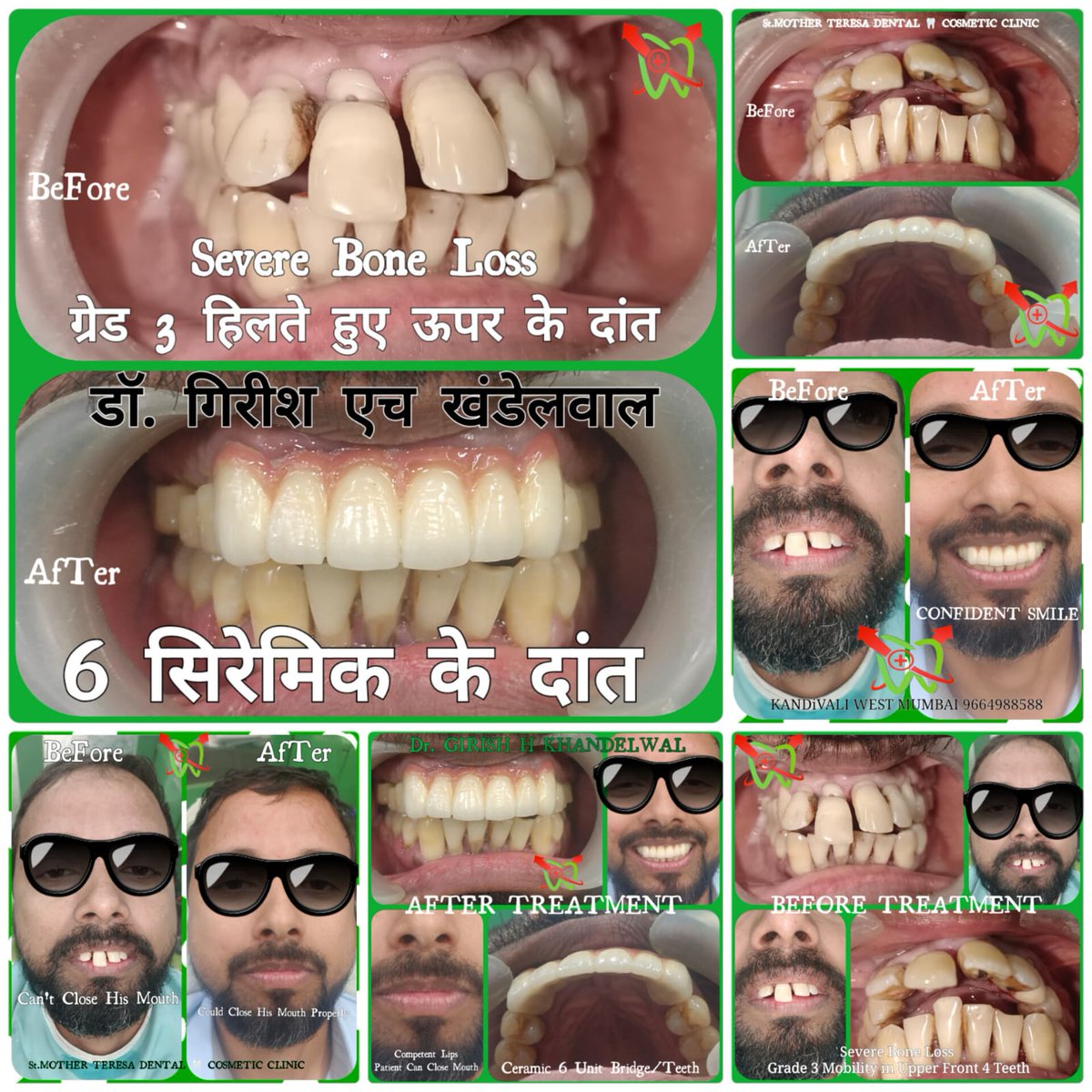 mother_dental's tweet image. PROBLEM :-
Shaking Teeth
Ugly Smile
Under confident Looks 
Bad Breadth
Pain &amp;amp; Pus
Improper Chewing From Front Teeth

Location :-
St.MOTHER TERESA DENTAL  COSMETIC CLINIC
Kandivali West-Mumbai

Dental Helpline No. :-
9664988588 | 9664988589

#ceramicteeth #ceramicrowns #teethgap