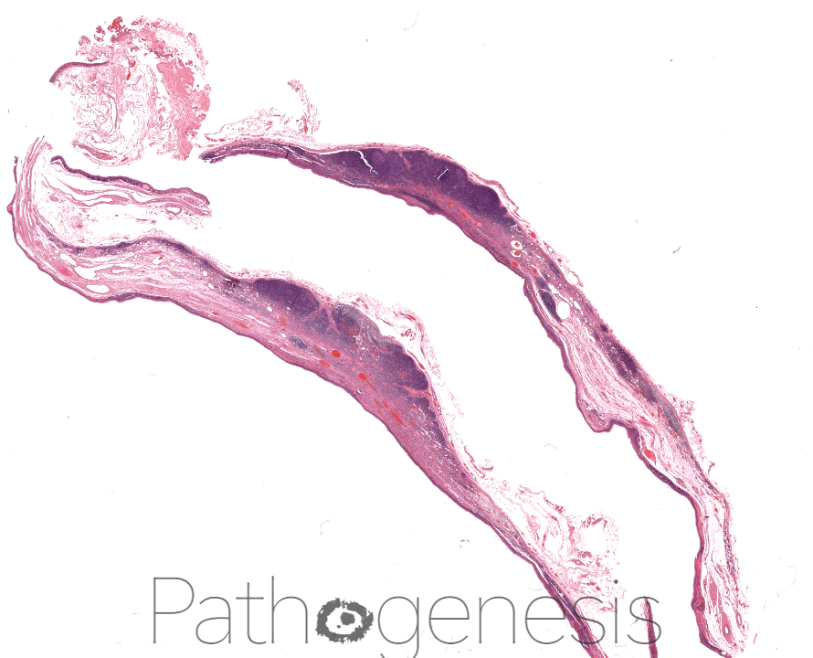 Wishing you all a very Happy New Year. @theBSOMP Case of the Month for Jan/Feb 2024 is now live. Visit bsomp.org.uk/cotm for details. Case credit-@histopathhannah @M0llieclark WSI credit-@pathogenesisDP