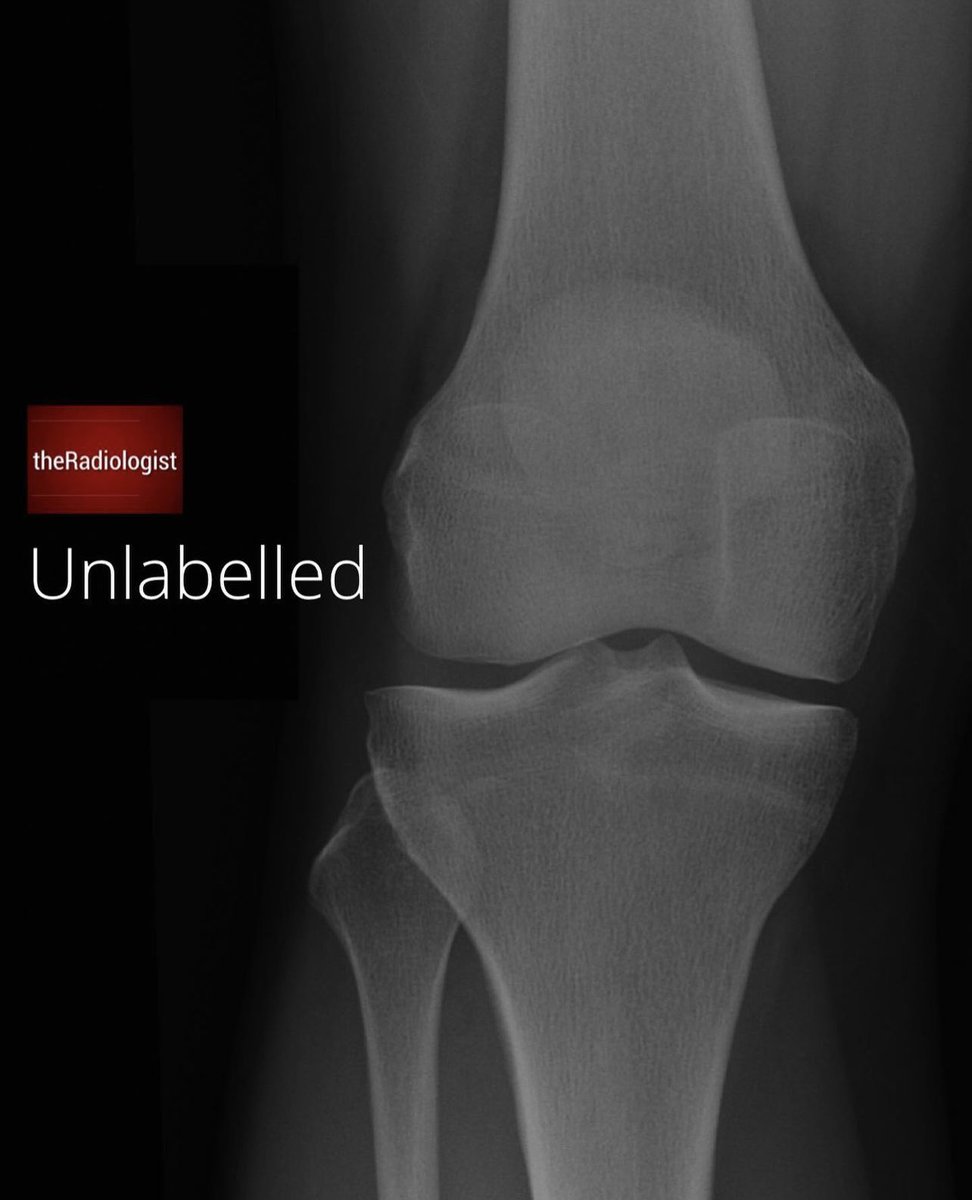 AbdullahNMT's tweet image. أناتومي الركبة في #الاشعة_السينية 🩻☢️
#knee #x_ray anatomy 🩻☢️