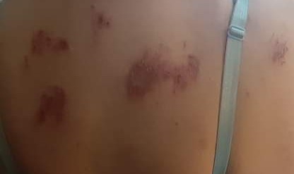 DevoidJustice's tweet photo. This is a photo of my mother's back in late 2022, alongside a victim of directed energy attack from the UK. 
I've watched them attack my loved ones, while they also attack me.
I've endured targeted comms used to psychologically isolate me from my loved ones.
#microwaveburn #RNM https://t.co/0uXNXGqTCZ