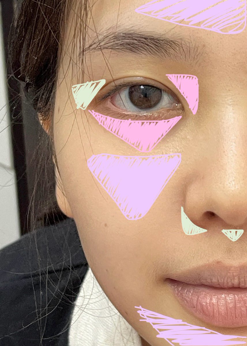 พวกรอยแดง เราใช้คอนซีลเลอร์พาเลท dasique สีเขียวไปช่วยกด ตามข้างจมูก ขอบตาแดงๆ ต่อมาเราอยากลดความเหลือง ใช้เป็นหลุมสีม่วง เกลี่ยบางๆลงช่วง หน้าแก้ม หน้าผาก คาง เกลี่ยให้กระจายออก เลเยอร์ไม่หนา สีม่วงช่วยลดผิวเหลือง + ทำให้บริเวณนั้นดู pop ขึ้นมา หน้าสดใสขึ้นมากก 

อันนี้