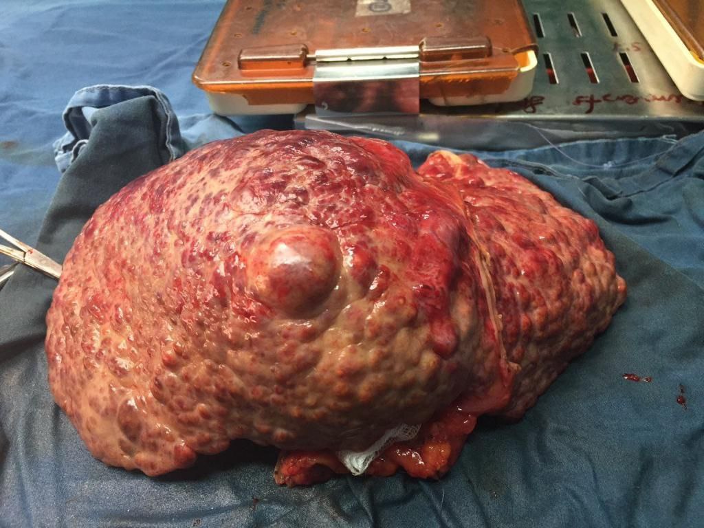 theliverdoc's tweet photo. Looks like everyone had a fantastic time this New Year, especially the youth.

So here is how a normal liver looks like (left) compared to one challenged with alcohol (right) with an exclusive once in a lifetime offer of liver cancer on it.

I have faith in current youth, because they will never let me go out of work.