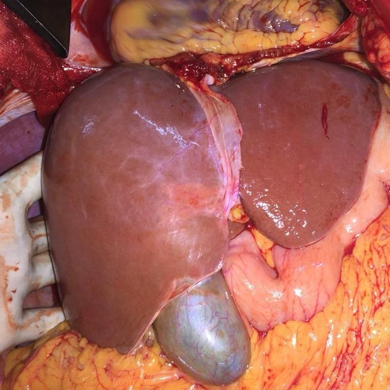 theliverdoc's tweet photo. Looks like everyone had a fantastic time this New Year, especially the youth.

So here is how a normal liver looks like (left) compared to one challenged with alcohol (right) with an exclusive once in a lifetime offer of liver cancer on it.

I have faith in current youth, because they will never let me go out of work.