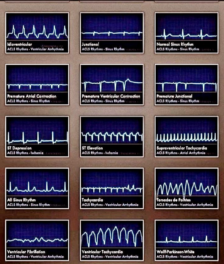 NeuroQuinn's tweet photo. Types of heart rhythms for beginners.
#Cardiology #ECG #ECGReading
#MedEd #FOAMed https://t.co/XKskwjhnlC