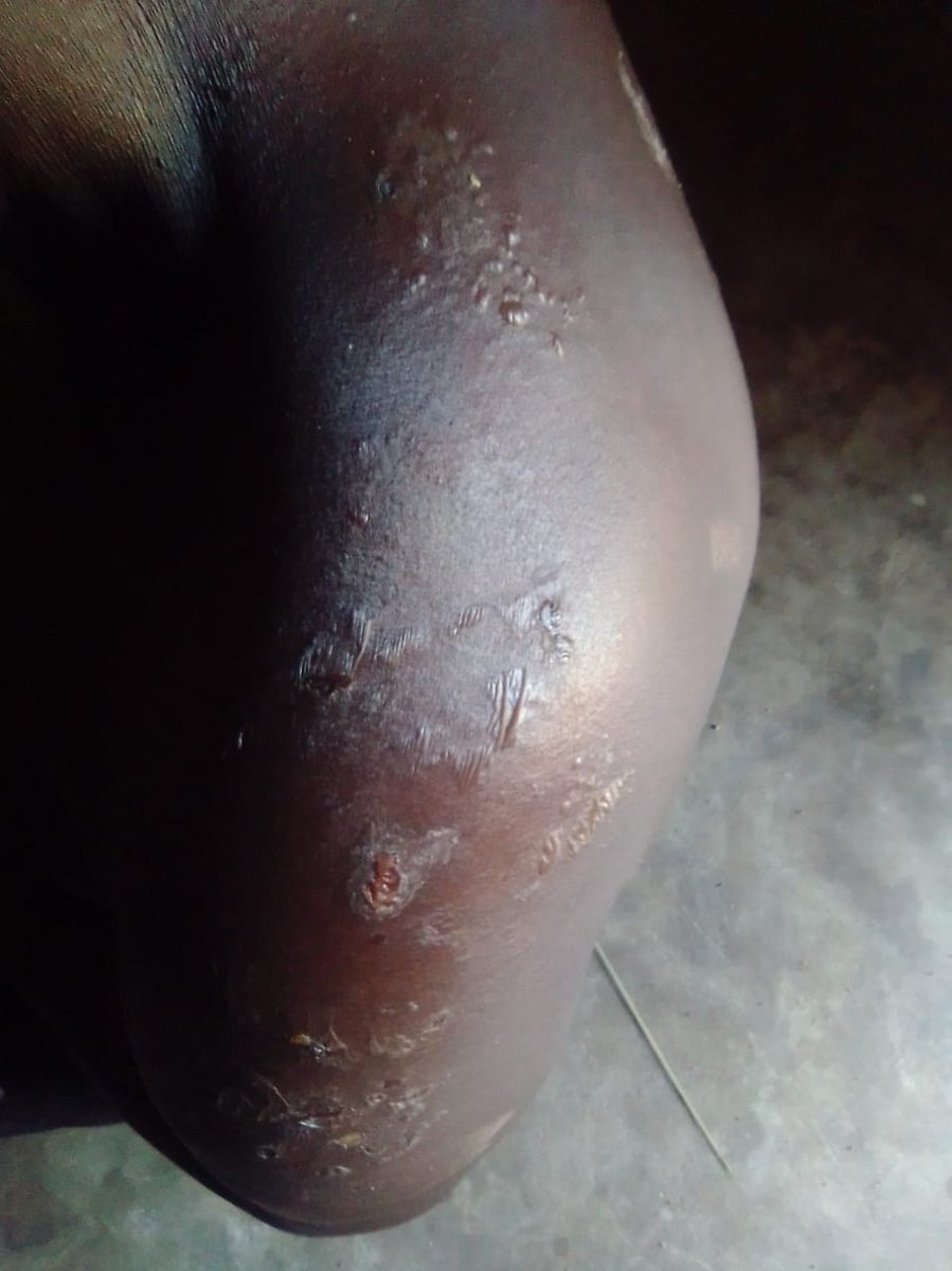 DocSplain's tweet photo. A 68-year-old female, known diabetic developed these itchy rashes all over the body since 2013.
No improvement. What could be the diagnosis and treatment?
#MedTwitter #MedX #MedEd #TwitterConsult #AskDocSplain https://t.co/Ck1N5Sze2h