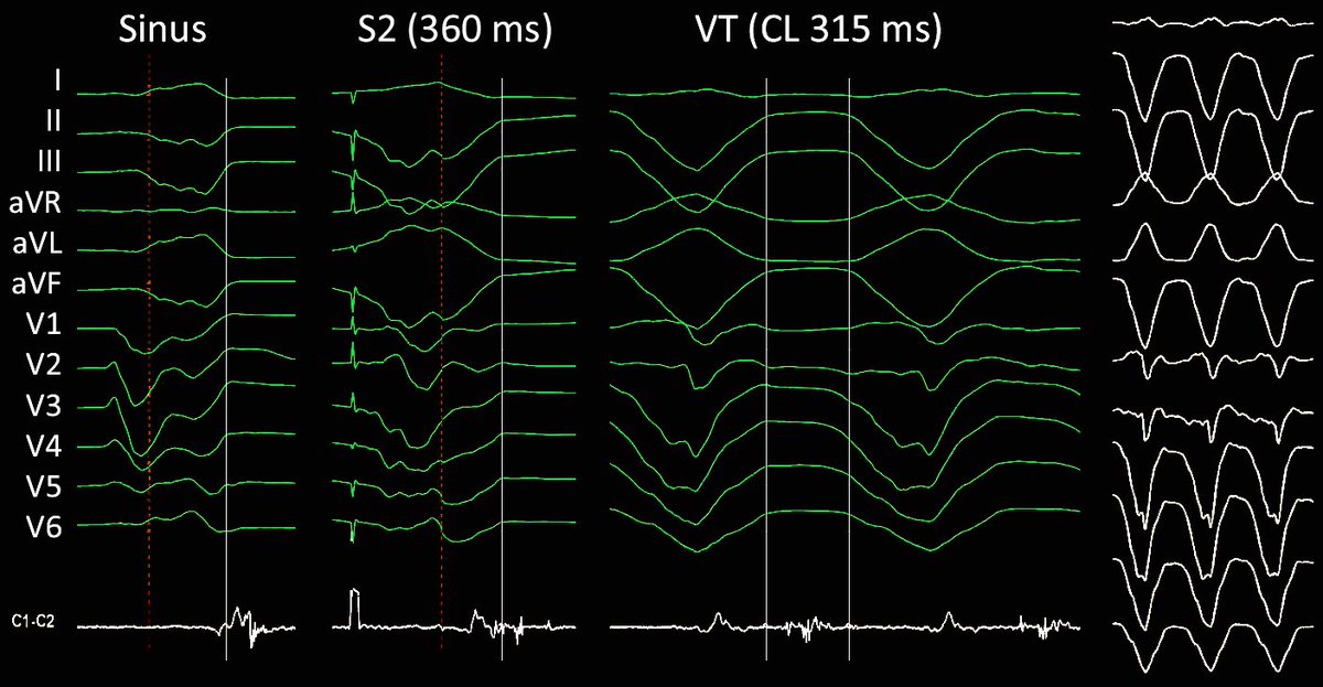 💥 Last case of #2023 💥 Getting later and later… ⏳ With @GiulioConte9, @EuropaceEiC #epeeps, #ablateVT