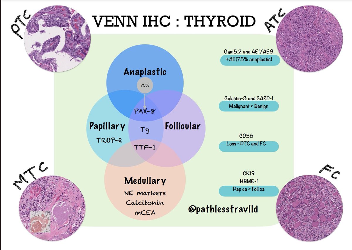 Venn #IHCPath is easy!

TROP-2 has recently been found to be highly specific for PTC!

#pathX #pathology #pathTwitter #EndoPath