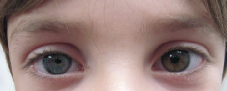 <a href="/OGdukeneurosurg/">Oren Gottfried, MD</a> Diagnosis✅:Horner syndrome 
-it is a neurological disorder characterised by 1️⃣miosis2️⃣Partial Ptosis3️⃣anhidrosis due to lesions in ipsilateral sympathetic nerve supply
Type✅:Preganglionic 
Etiology✅:Breast,Pancoast compressing stellate ganglion,CVC,lymphadenopathy #MedTwitter