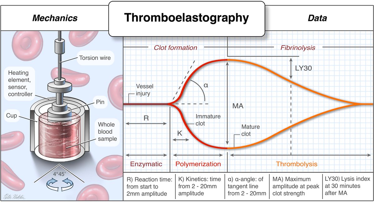 Review of Thromboelastography (TEG): Medical and Surgical Applications CCR Journal Watch criticalcarereviews.com/latest-evidenc… Get the latest critical care literature every weekend via the CCR Newsletter - subscribe at criticalcarereviews.com/newsletters/su…