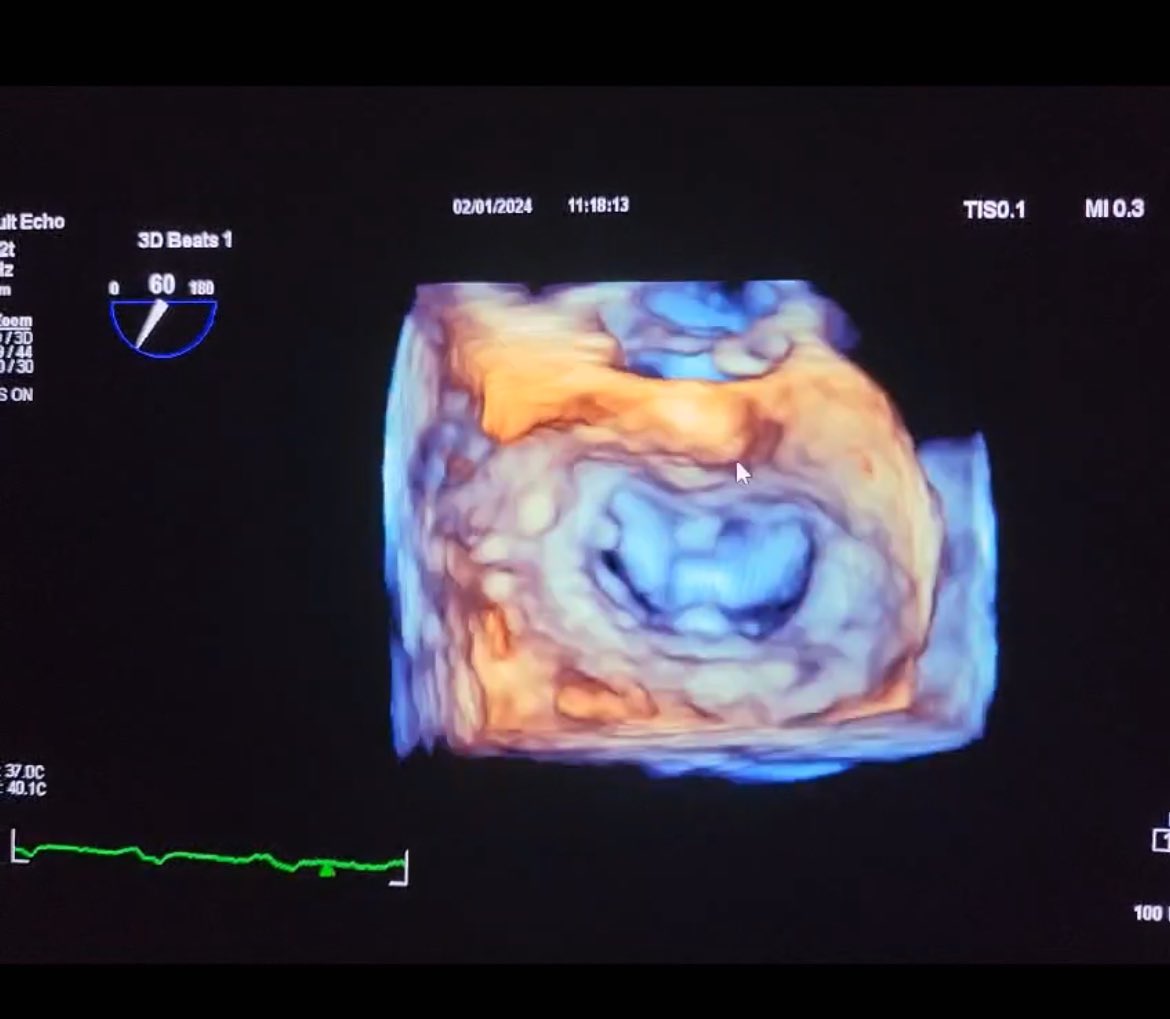 Starting 2024. With two cases of Evolut Fx on the launch day.” And a successful MitraClip. Our experience of previous years helps us to treat our patients better and safer.
#TAVI #MITRACLIP #SAFETAVI #tavr 
#RHL