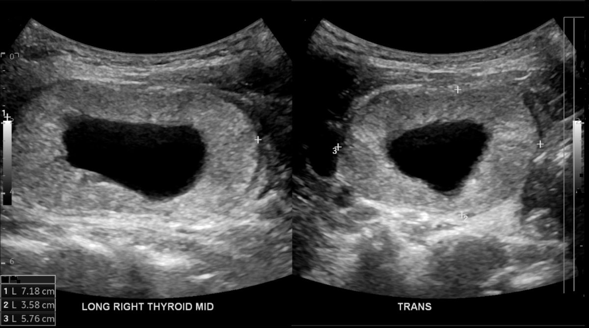 DrIramHussain's tweet photo. #Thyroidultrasound shows giant donut-shaped #thyroidnodule reported as #TIRADS 2. 🍩
#FNAbiopsy/#ThyroidFNA with #cytopath showing Bethesda III (AUS), #ThyroSeq: Low Risk 🔬
Partial #thyroidectomy with surgical #pathology showing papillary #thyroidcancer! 🦋
#FNAFriday https://t.co/30LQoAXYhn