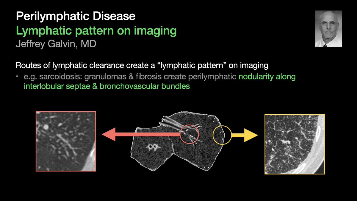 Review of Perilymphatic Disease:
Pulmonary lymphatics &amp; the “lymphatic pattern” on imaging.

[1/5]

…from Dr. Jeffrey Galvin’s talk at #STR2021 &amp; condensed by @MikeHarowiczMD.

#radres #Radtwitter #MedTwitter #FOAMrad #FOAMmed