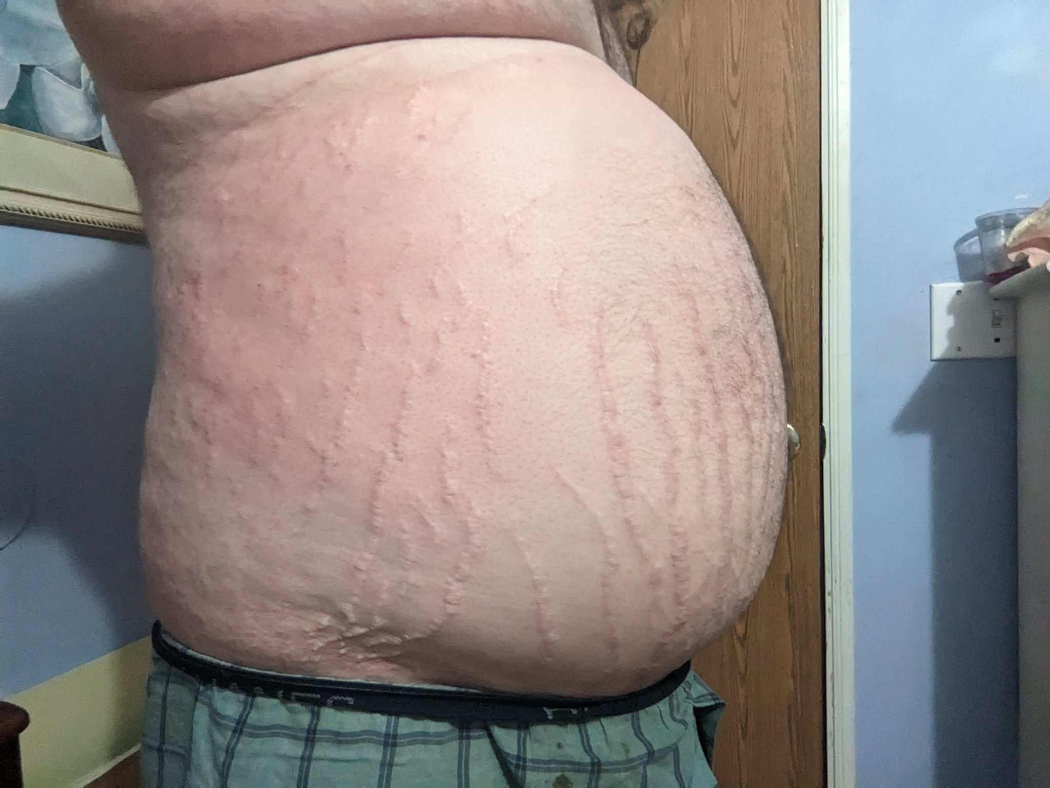 2 pic. Smallish N2O inflation today. Didn't want to push myself. https://t.co/OtnEozlLwr
