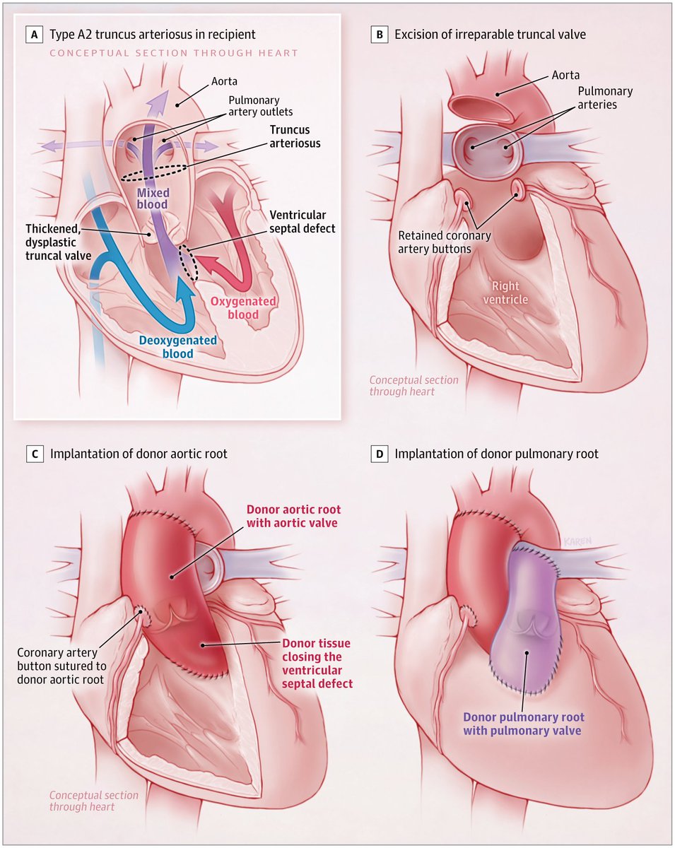 Case report: the first partial heart transplant in a neonate with irreparable heart valve dysfunction to deliver aortic and pulmonary valves that grow with the developing child. 

ja.ma/48kOuGs