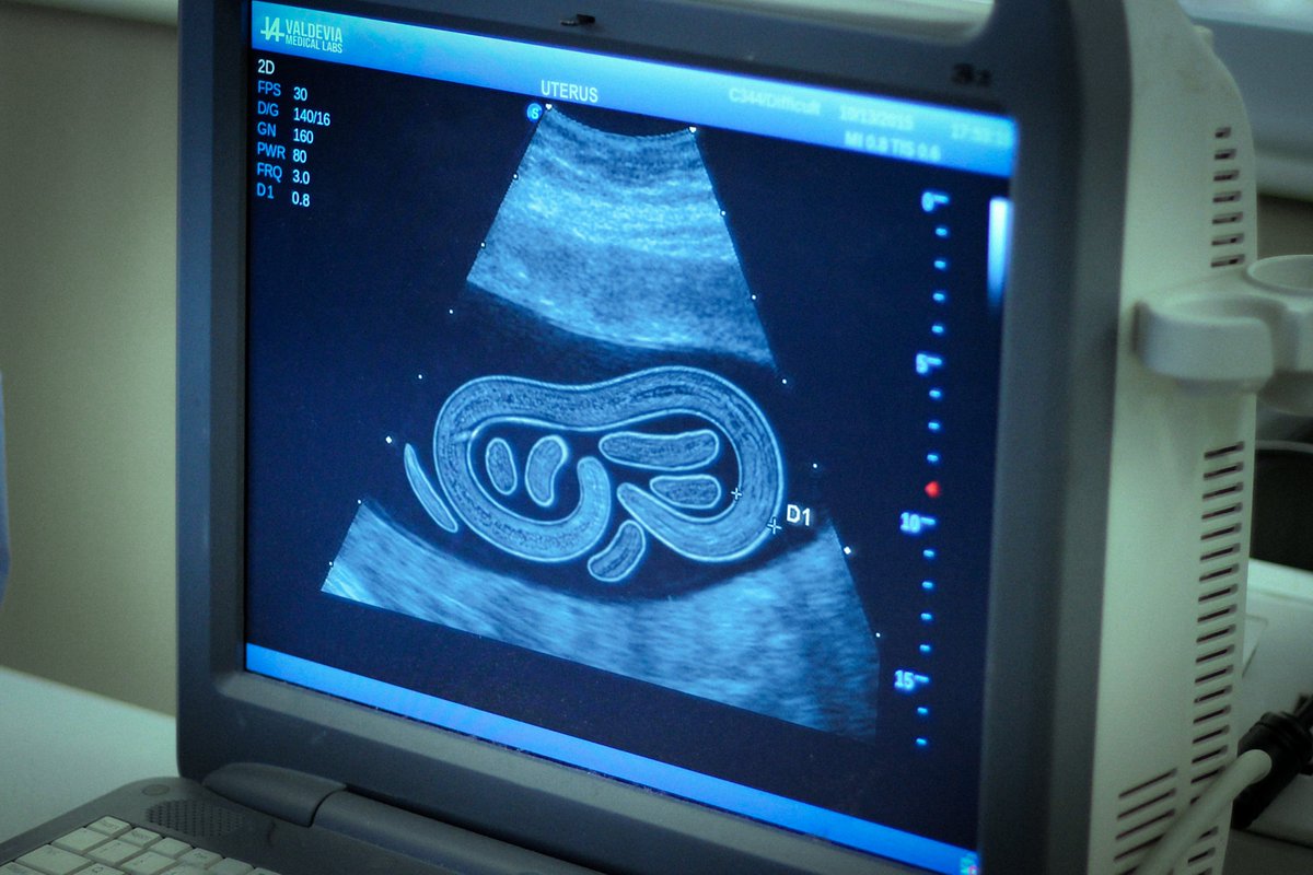 Valdevia_Art's tweet photo. Dracunculus graviditatis is a specialized parasite of the uterus.
Ingested larvae pass the intestine and migrate to the uterine wall, releasing anandamide and hCG analogues. This tricks the body into a false pregnancy state, which the nematode uses to grow to lengths of up to 2m. https://t.co/UbkyffOXrT