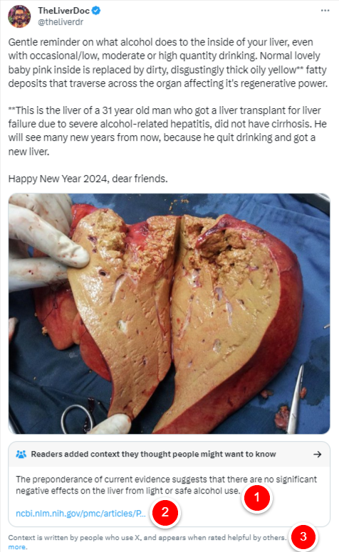 theliverdoc's tweet photo. Need a @CommunityNotes  for @CommunityNotes  when it comes to alcohol. 

1⃣There is no evidence to suggest that low alcohol use is safe for the liver. In fact, there is evidence to suggest that there is nothing called as "safe alcohol use."
https://t.co/FRTnTOlyuM

2⃣The peer reviewed publication to support the statement 1⃣ in @CommunityNotes is in fact inaccurate and not related to the original post. 

The link claims that low or modest alcohol use and its impact in NAFLD (non-alcoholic fattty liver disease) remains unproven. Absolutely false. 

🍺Even low alcohol intake in fatty liver disease is associated with increased risks for advanced liver disease and cancer and moderate alcohol consumption was associated with advanced fibrosis in non-alcoholic fatty liver disease - https://t.co/fghel3SOdP and https://t.co/k8AZl7Zjr5 

🍺In a Finnish study, even low alcohol intake in fatty liver disease was associated with increased risks for advanced liver disease and cancer. In a South Korean study, even though low alcohol consumption was linked to a decreased risk of incident hepatic steatosis, the same levels of low alcohol consumption were associated with a higher risk of developing advanced liver fibrosis in those subjects who progressed to more severe NAFLD over time - https://t.co/EG1cnqJsGd

3⃣The @CommunityNotes content under the original post was written by people who were enjoying their alcohol on New Years and chanced upon the post, pissed their pants and cherry picked data from the internet to calm themselves and others down from the reality check they were exposed to.