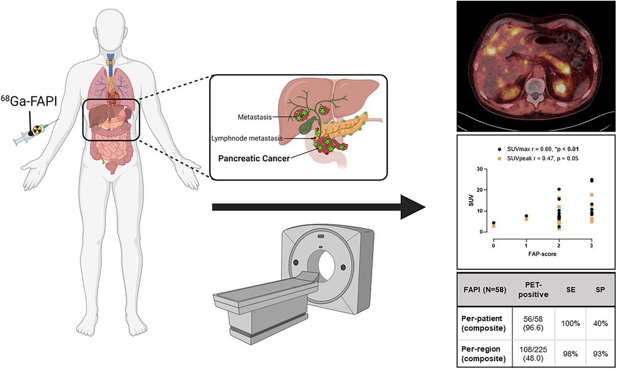 In pancreatic adenocarcinoma, 68Ga-FAPI PET-CT's  detection rate and diagnostic accuracy are superior to 18F-FDG PET-CT 
jnm.snmjournals.org/content/64/12/…