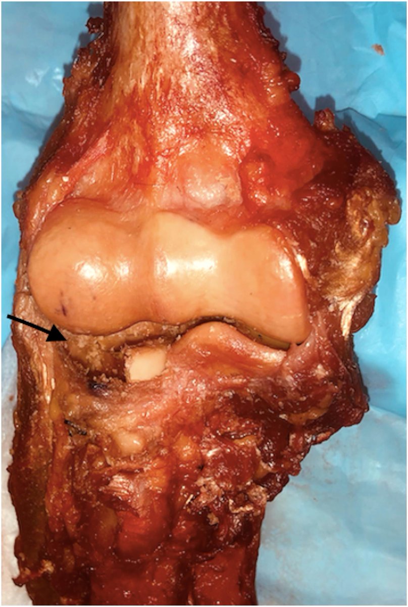 Radiocapitellar and Ulnotrochlear Pressures Increase in a Radial Head Fracture Model
#basicscience #trauma #shoulderelbow

bit.ly/3vrahgU