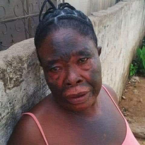 BulletinSante's tweet image. 🥵#Dépigmentation: il faut faire attention!!!!

De +en+ les femmes ont des difficultés pour tomber enceinte.Nous avons de +en+ des malformations à la naissance qui sont imputables à ces produits. 

#Dr_Daouda_Sigué, spécialiste de la fertilité