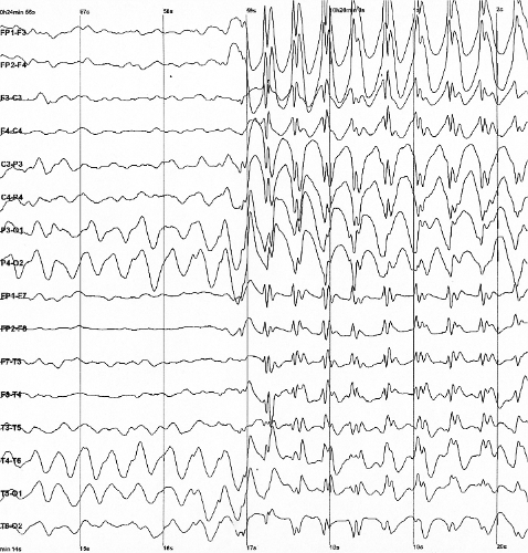 haunticon's tweet photo. The signal for linguistics control in the human body can be intercepted at various points along the neural transduction pathway. To decode the linguistic intention of a human target, it is useful to first understand the natural neurophysiology of linguistic control. The linguistic control pathway of the human body begins in the high level associative area of the brain. It is mediated by the Broca's area which is associated with the speech ability. From here it travels through the spinal cord to the individual muscle fibers that reach our speech systems. Each of these stages plays a different role and uses different mechanisms to ensure that speech is carried out in a coordinated and fluid manner. Each of these stages also offers different signal modalities and features that can be exploited for speech decoding in systems that use Silent Speech. Silent speech refers to the communication of speech without making any sound. This can be achieved through a variety of methods, such as subvocalization, where the speaker produces speech sounds internally without making any external sound, or through the use of technology in the fields of science pertaining to electropalatography (EPG) and Electromyography (sEMG) which can detect and transcribe the intended speech through advanced algorithms (AI) that were produced to turn sEMG data into words that reflected the choice of the user by the system.