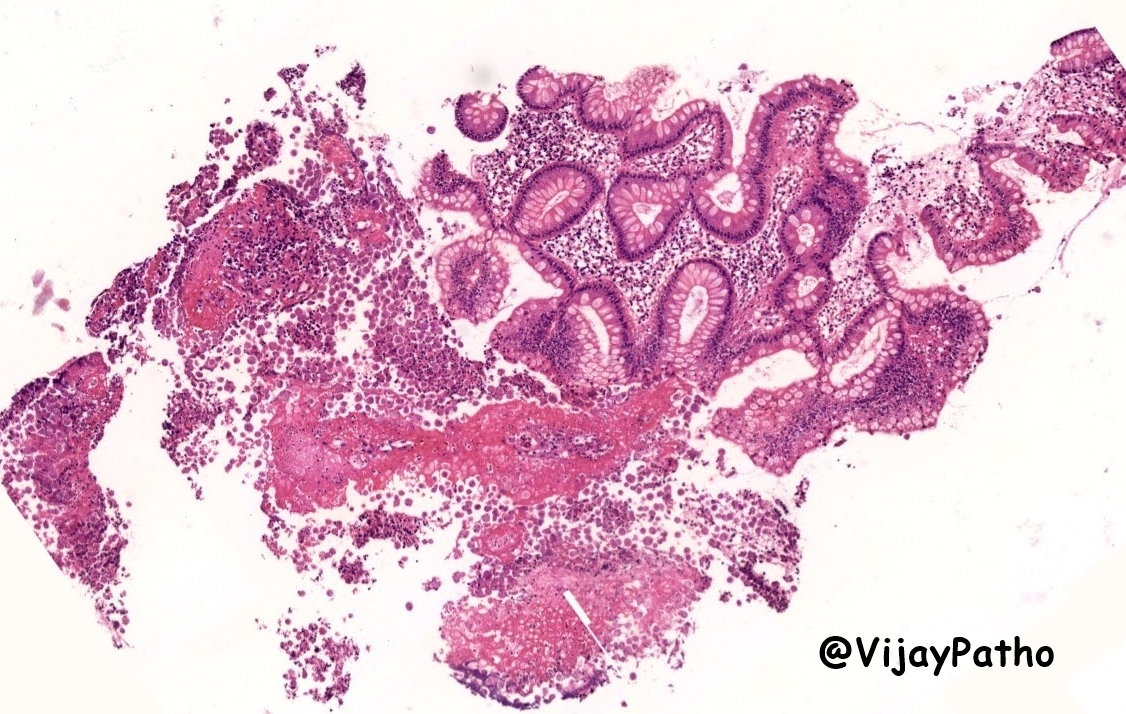 VijayPatho's tweet image. #CrittersOnTwitter #GIPath #pathbugs #Pathclassics 
35/M  Worry Dismissed!! @smlungpathguy @kriyer68 @vi_monappa @RunjanChetty @DrGeeONE @ariella8 @archibhat3 @RamyaPathology @Thejaspatho @PanditApoorva @Baskotacytopath @prachipath123 @DrAhmedKalebi @pembeoltulu @HermelinMD