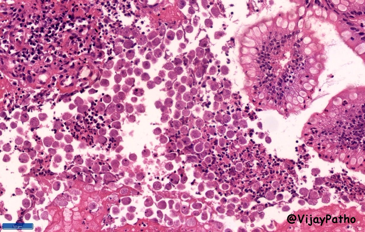 VijayPatho's tweet image. #CrittersOnTwitter #GIPath #pathbugs #Pathclassics 
35/M  Worry Dismissed!! @smlungpathguy @kriyer68 @vi_monappa @RunjanChetty @DrGeeONE @ariella8 @archibhat3 @RamyaPathology @Thejaspatho @PanditApoorva @Baskotacytopath @prachipath123 @DrAhmedKalebi @pembeoltulu @HermelinMD