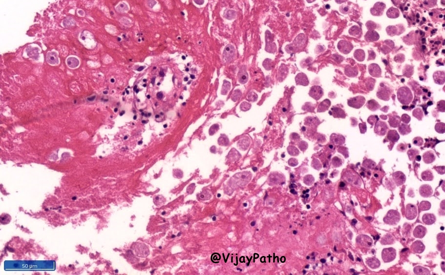 VijayPatho's tweet image. #CrittersOnTwitter #GIPath #pathbugs #Pathclassics 
35/M  Worry Dismissed!! @smlungpathguy @kriyer68 @vi_monappa @RunjanChetty @DrGeeONE @ariella8 @archibhat3 @RamyaPathology @Thejaspatho @PanditApoorva @Baskotacytopath @prachipath123 @DrAhmedKalebi @pembeoltulu @HermelinMD