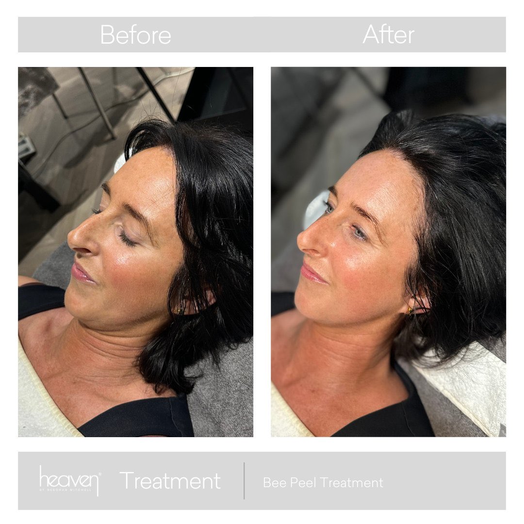 Salon_Heaven's tweet photo. A #beestingfacial in action https://t.co/FgTTQOGvK4