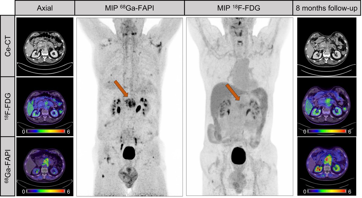 SNM_MI's tweet photo. PET imaging with ⁶⁸Ga-FAPI can more effectively detect and stage pancreatic cancer compared with ¹⁸F-FDG imaging or contrast-enhanced CT, according to research from @JournalofNucMed.  Read more: https://t.co/UqL5JZcgIg

#NuclearMedicine #PancreaticCancer #MolecularImaging https://t.co/551cmQ1C4q